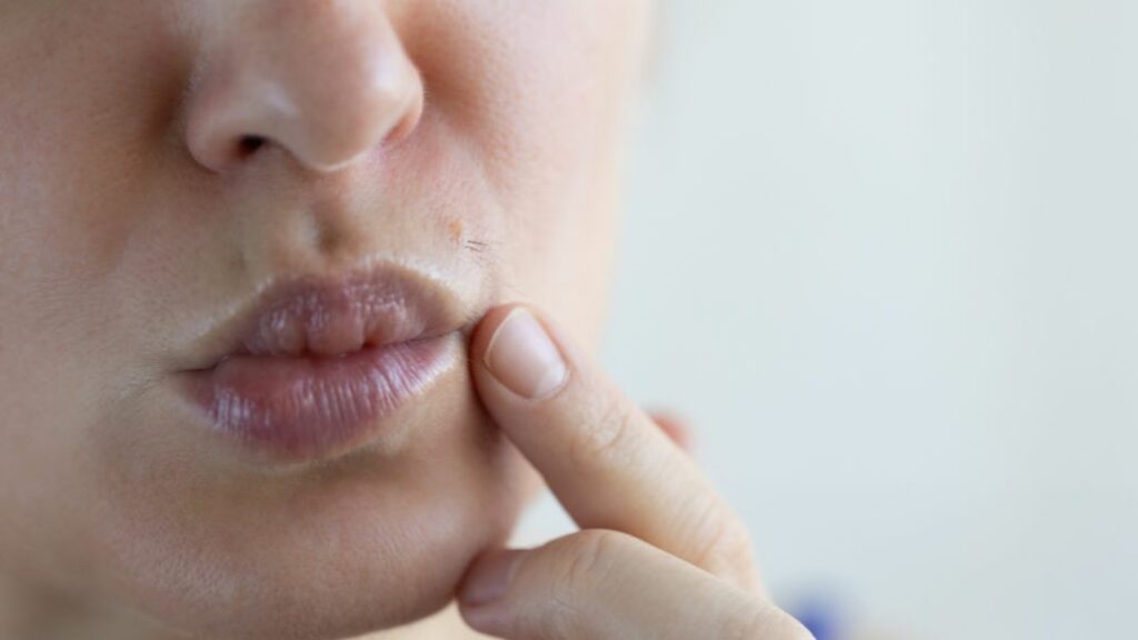 Unwanted Facial Hair Online Treatment